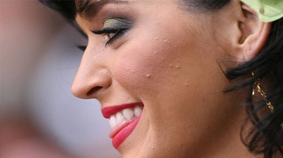 katy_perryacne