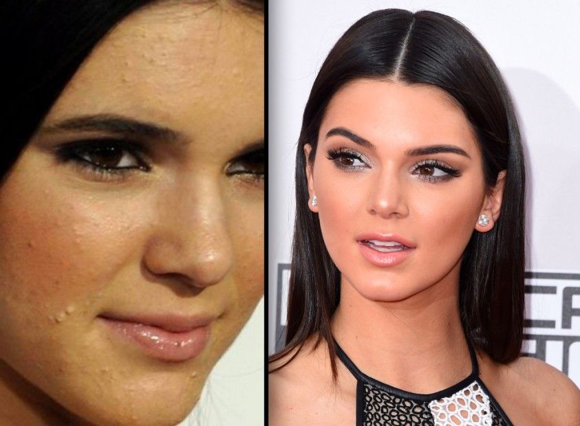 kendall jenner e i suoi problemi di acne